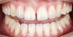 How Can I Close a Gap Between My Front Teeth?