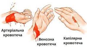 Презентація до уроку "Види кровотеч"