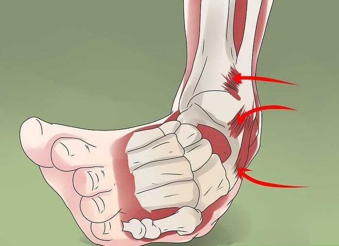 Sprained Ankle Treatment in Sydney (A Guide To Help You With Your Ankle Sprain)