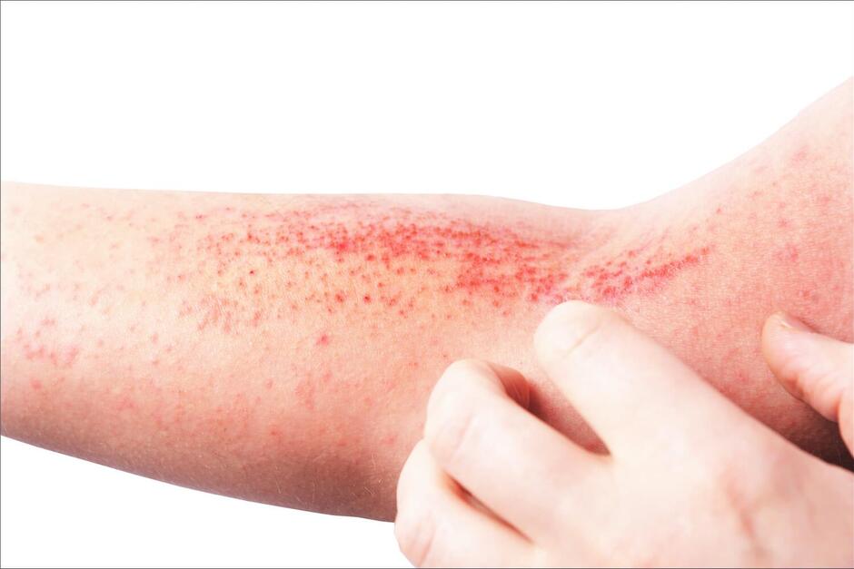 Contact Dermatitis - Dr. Sergio Mazzei | Wound Care