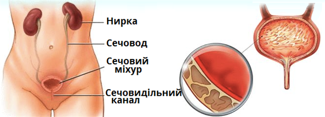 цистит.png