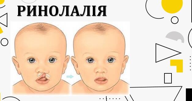 Презентація з теми: "Ринолалія" | Інші методичні матеріали. Логопед
