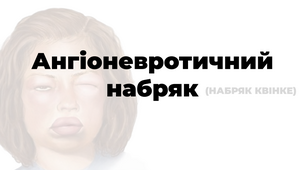 Презентація "Ангіоневротичний набряк (набряк Квінке)".