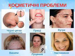 Косметичні проблеми підлітків - презентація з медицини