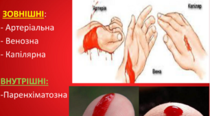 10, 11 клас. Види кровотеч. Зупинка кровотечі.