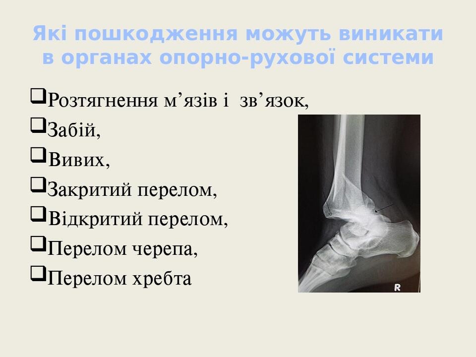 Які пошкодження можуть виникати в органах опорно-рухової системи Розтягнення м’язів і  зв’язок, Забій, Вивих, Закритий перелом, Відкритий перелом, ...