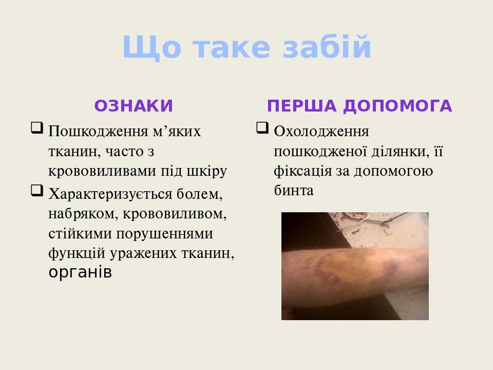 Що таке забій Ознаки Пошкодження м’яких тканин, часто з крововиливами під шкіру Характеризується болем, набряком, крововиливом, стійкими порушенням...