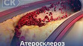 Дисципліна внутрішня м-на Функції медсестри при атеросклерозі №2