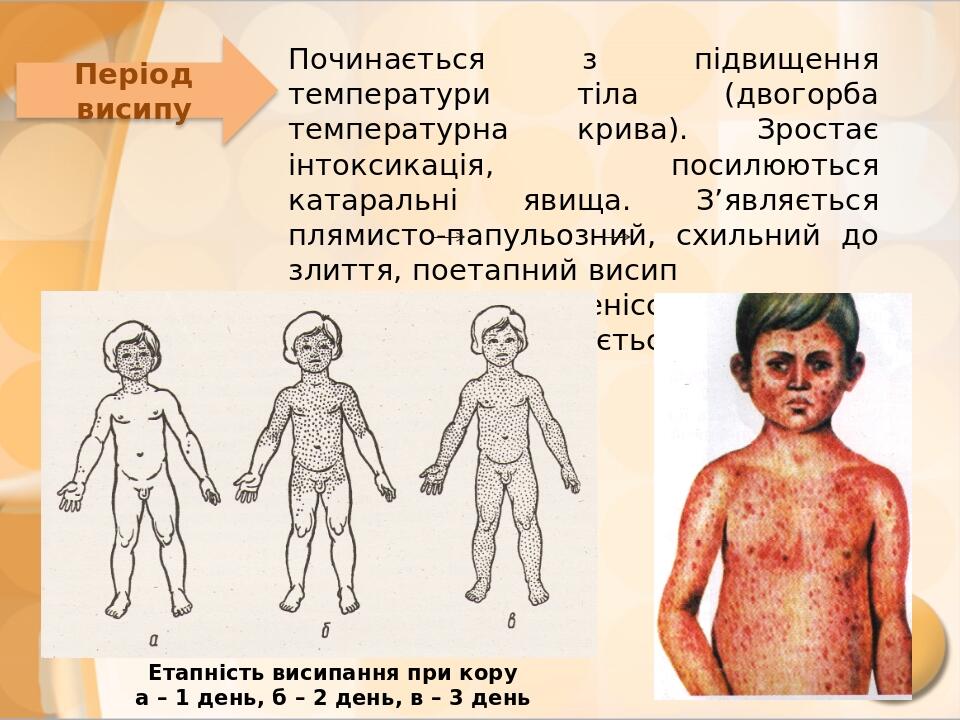 Презентація Кір Краснуха Скарлатина Вітряна віспа Презентація Медсестринство в педіатрії