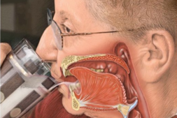 Dysphagia