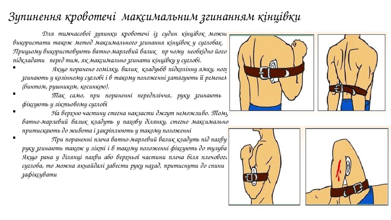 Для тимчасової зупинки кровотечі із судин кінцівок можна використати також метод максимального згинання кінцівок у суглобах. Прицьому використовуют...