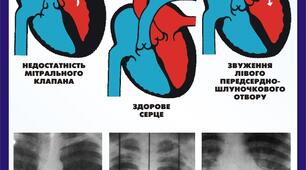 Д-на внутрішня м-на Медсестринська опіка над пацієнтом при мітральних та аортальних вадах серця № 6,7