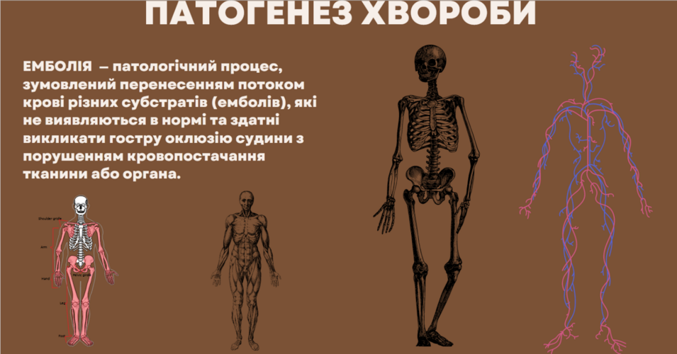 Презентація "Емболія"