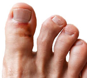 How To Treat A Broken Toe - AccidentClaimsAdvice.org.uk