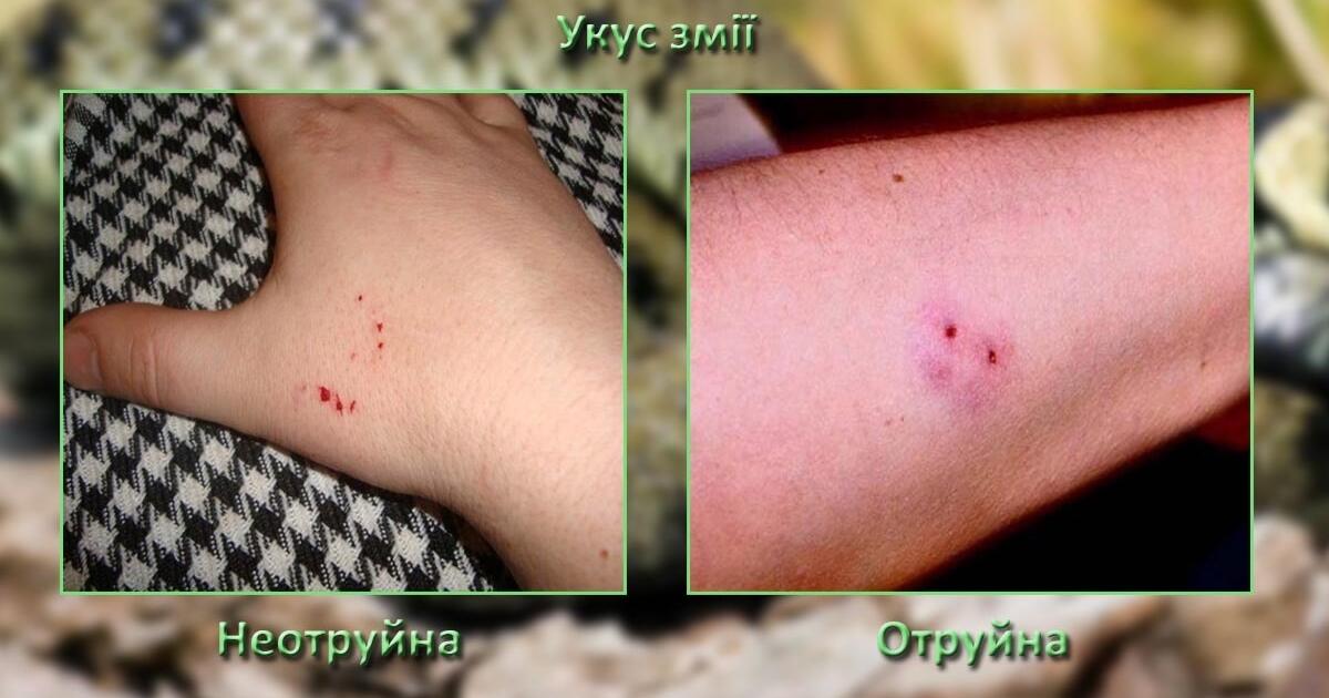 (Копія) Укуси змій, комах та тварин | Тест на 13 запитань. Захист України