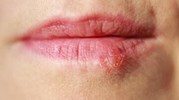 Prehistoric roots of cold sore virus traced through ancient DNA