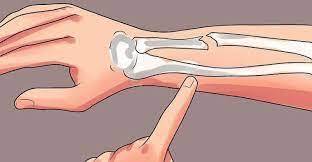 Закрытый перелом - признаки, причины, симптомы, лечение и профилактика - iDoctor.kz
