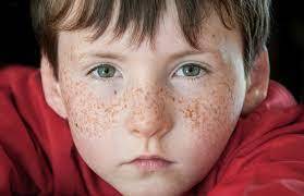 What Causes Fabulous Freckles? - Kids Discover